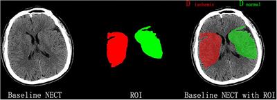 Net Water Uptake Calculated in Standardized and Blindly Outlined Regions of the Middle Cerebral Artery Territory Predicts the Development of Malignant Edema in Patients With Acute Large Hemispheric Infarction